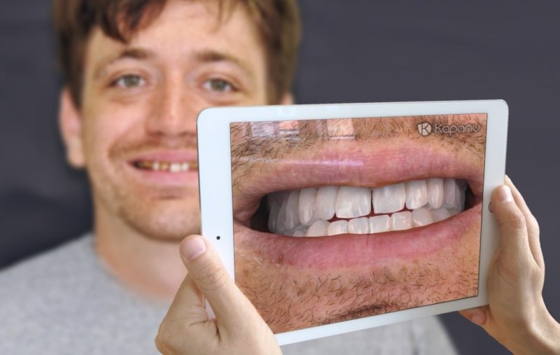 Kapanu：口腔内を3Dスキャンし、義歯の完成イメージを患者と共有